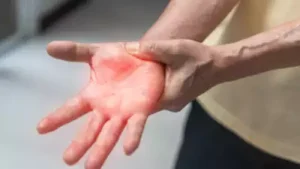 Guillain-Barré Syndrome cases Pune Maharashtra